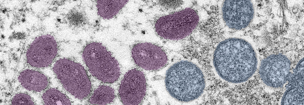 Monkeypox outbreak echoing stigmas, fears of early HIV/AIDS era